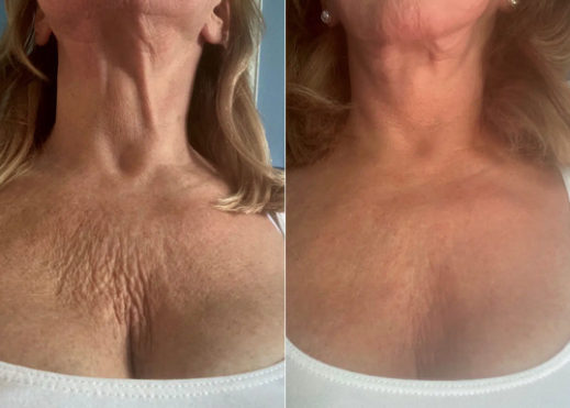 Before and after: neck skin visibly firmer after two days of use